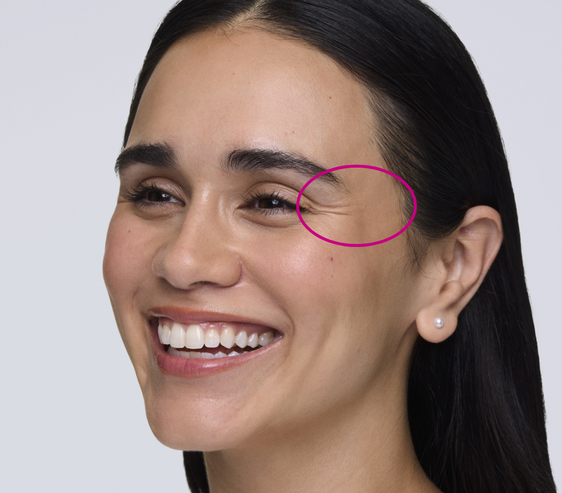 Woman patient Prsicilla smiling showing lines next to her eyes also known as 'crow's feet'.