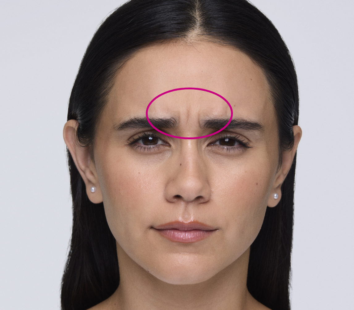 XEOMIN patient Priscilla scrunching her face showing lines between her eyebrows also known as '11's'.